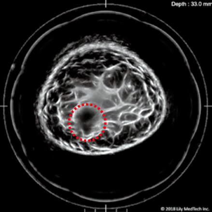 癌症患者的乳房三维图像。在高密度乳房内成功拍摄到了15毫米的癌症部位（红色虚线内）