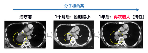 日本查明肺癌细胞如何在分子靶向药物中存活