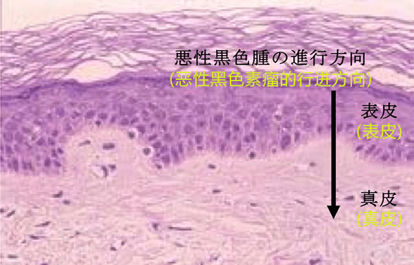 日本东北大学等成功通过导热率判断皮肤癌的程度