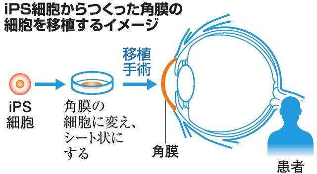 日本iPS细胞研究报告(廿七) 阪大篇：世界首例iPS角膜移植