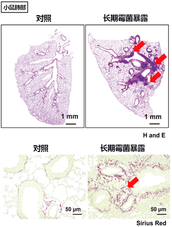 治疗霉菌性肺纤维化的关键！日本明确导致肺部组织纤维化的新细胞群