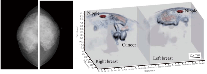 神户大学开发成功新型微波乳腺癌诊断仪