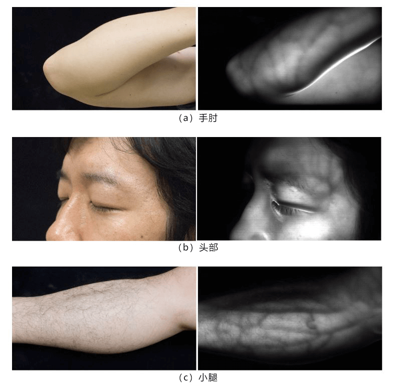 日本开发出非接触实时清晰显示皮下血管的技术，有望应用于注射、采血等医疗用途