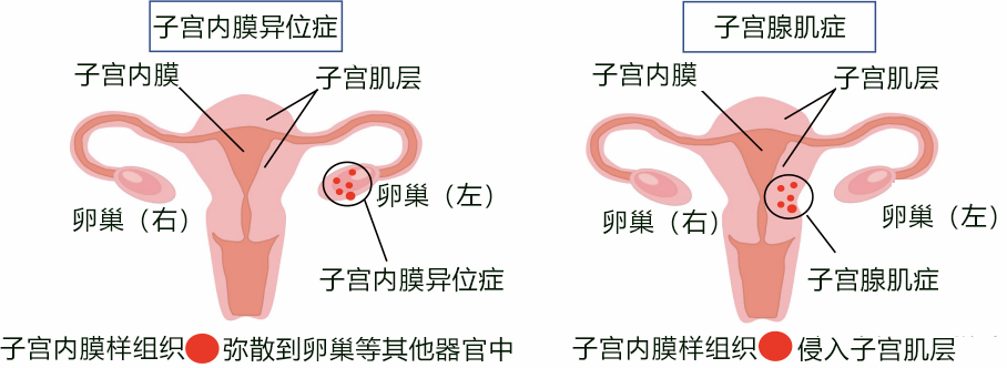 日本发现导致子宫腺肌症发病及并发子宫内膜异位症的基因突变