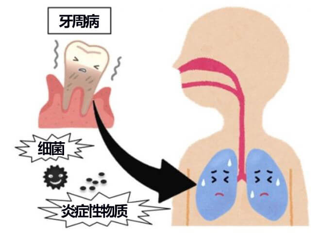 牙周病会影响肺部健康