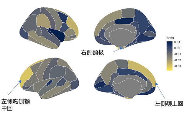 福井大学：儿童使用信息终端的时间与ADHD症状相关，对大脑构造有影响
