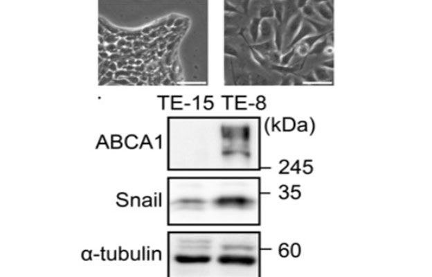 九州大学等阐明脂质代谢失衡会导致抗癌药难以收效的分子机制 为开拓新治疗策略开辟道路