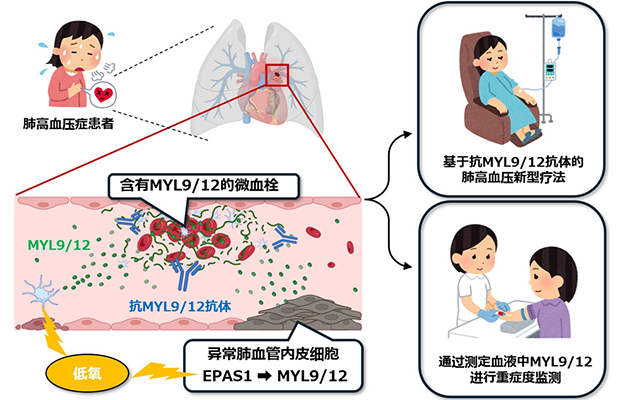 千叶大学鉴定出导致难治性疾病“肺高血压症”恶化的蛋白质“MYL9/12”，会引发血管结构恶化