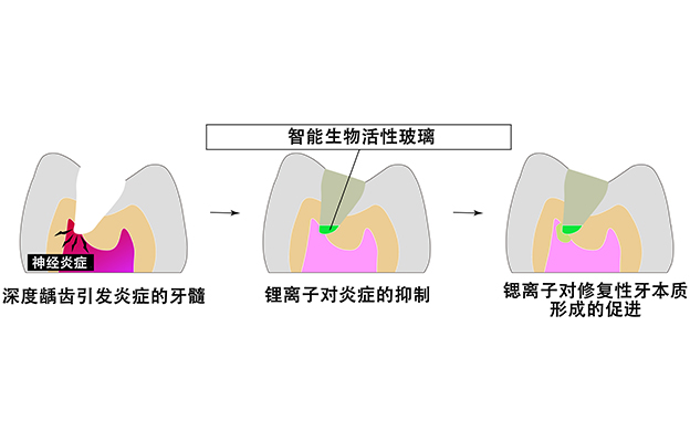 大阪大学开发可分阶段释放离子的玻璃粒子，有望实现“无需拔除牙神经”的龋齿治疗
