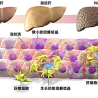名古屋大学发现巨噬细胞中的胆固醇积累会促进肝纤维化使症状恶化