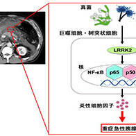 近畿大学明确肠道真菌感染诱发急性胰腺炎重症化的机制，为重症急性胰腺炎找到新的治疗靶点