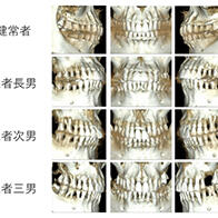 广岛大学明确年轻人群中高发的侵袭性牙周炎致病基因