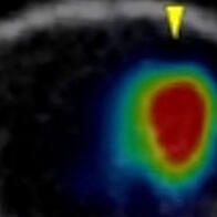 横滨市立大学：放射性药物局部给药对小鼠恶性脑肿瘤有效