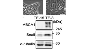 九州大学等阐明脂质代谢失衡会导致抗癌药难以收效的分子机制 为开拓新治疗策略开辟道路