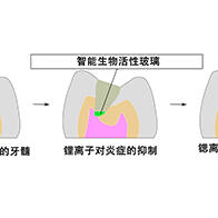 大阪大学开发可分阶段释放离子的玻璃粒子，有望实现“无需拔除牙神经”的龋齿治疗