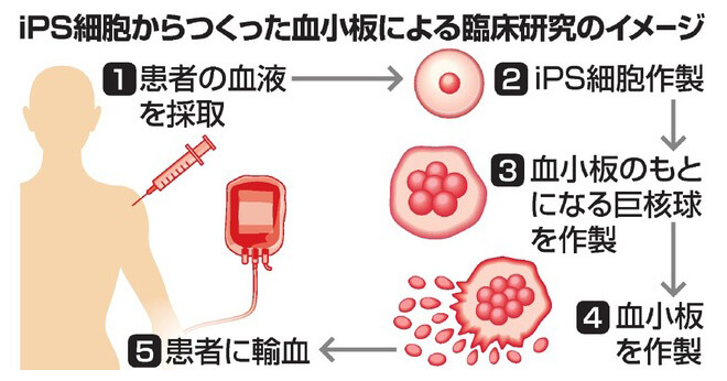 基于iPS细胞的血小板临床研究示意图