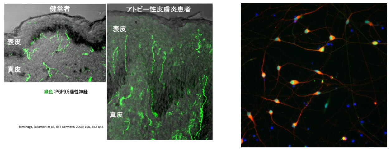 左为皮炎患者神经纤维(绿色)侵入表皮；右为iPS由来感觉神经元的纤维