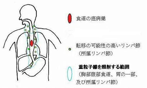 重粒子线癌症治疗报告　食道癌：3年及5年生存率分别达到86%和81%