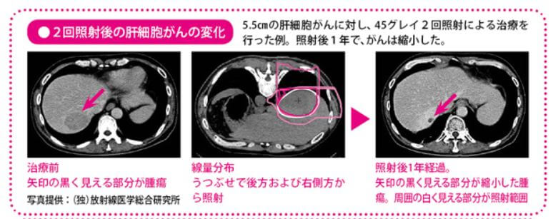 重粒子线癌症治疗报告 肝癌:3年生存率为73%