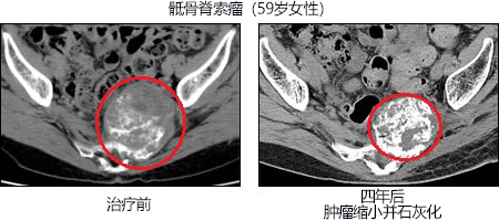 重粒子线癌症治疗报告 软组织骨肉瘤:5年生存率达到45%