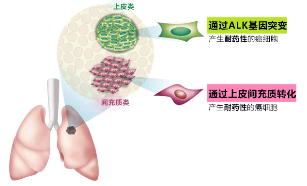 金泽大学查明肺癌细胞的分子靶向药物耐药性机理