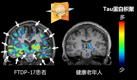 日本查明遗传性痴呆症发生的脑内异常