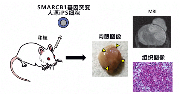 日本京都大学与东京大学利用人源iPS细胞制作脑肿瘤模型，查明儿童脑肿瘤病理