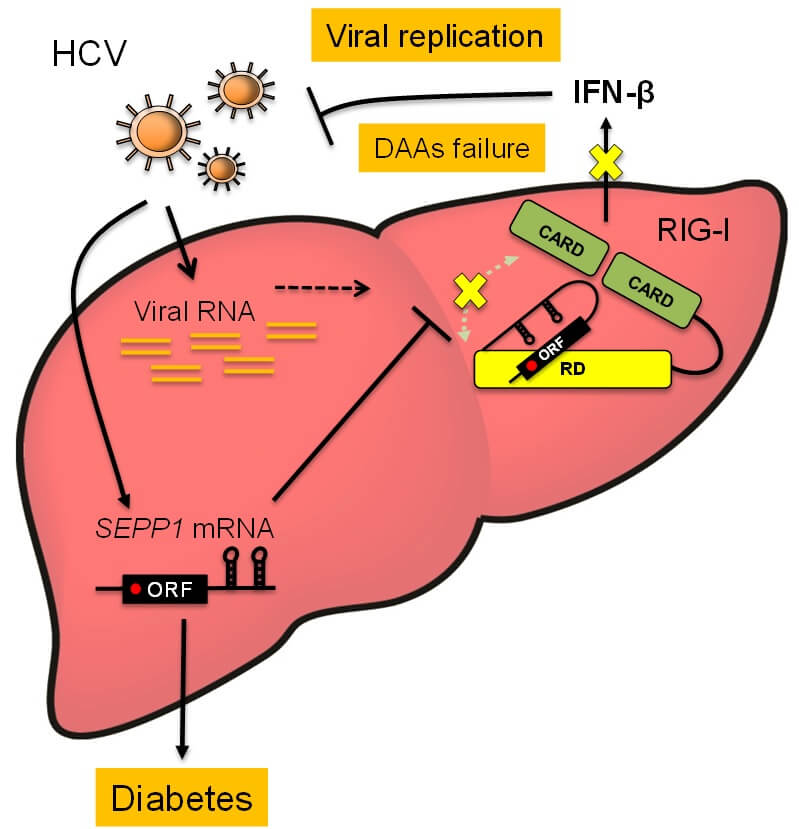 金泽大学查明对于丙肝并发二型糖尿病干扰素治疗效果差的机理