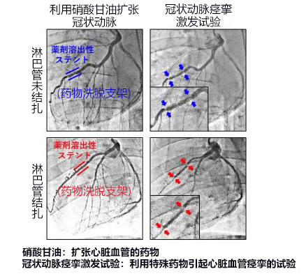 全球首次！日本查明心脏淋巴流与心绞痛之间的关系