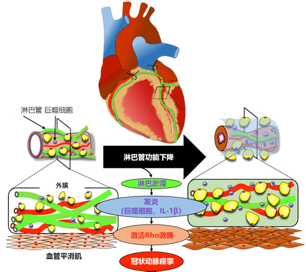 全球首次！日本查明心脏淋巴流与心绞痛之间的关系