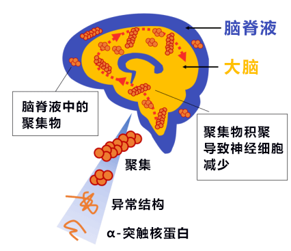 大阪大学成功从患者脑脊液中检测出帕金森病致病蛋白聚集物