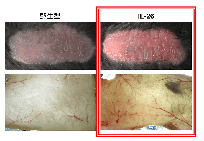 顺天堂大学查明银屑病等皮肤病恶化机制