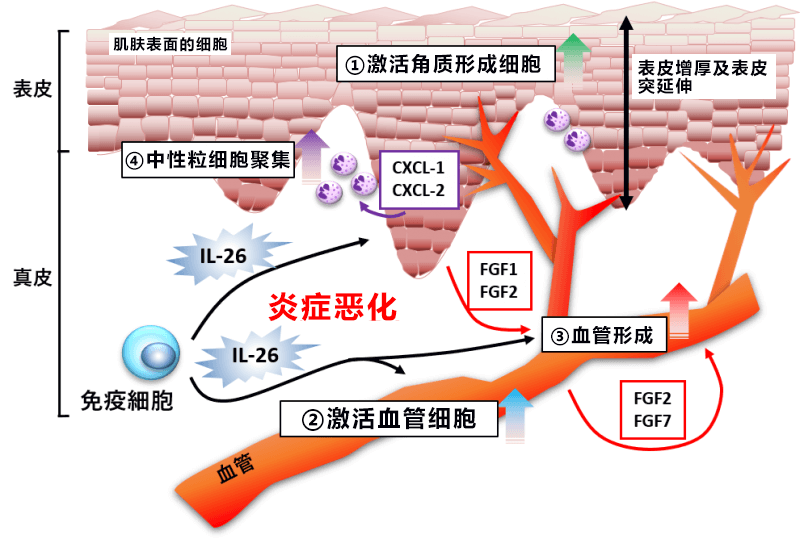 顺天堂大学查明银屑病等皮肤病恶化机制