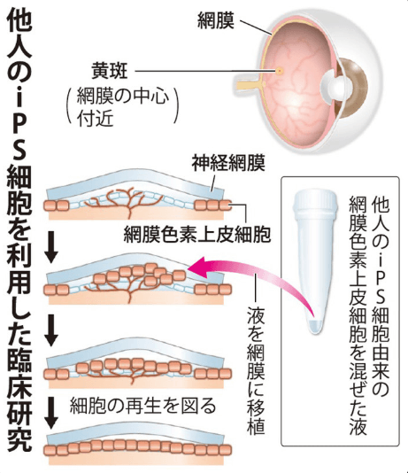 日本iPS细胞研究报告(廿九) 理研篇:确认视网膜移植试验安全性