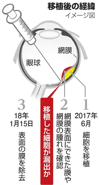 日本iPS细胞研究报告(廿九) 理研篇：确认视网膜移植试验安全性