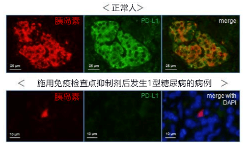 日本查明施用免疫检查点抑制剂后引发1型糖尿病的部分原因