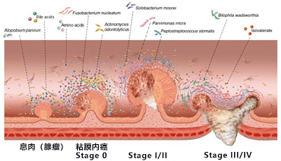 检查粪便可早期确诊大肠癌，日本发现大肠癌特征性细菌和代谢物
