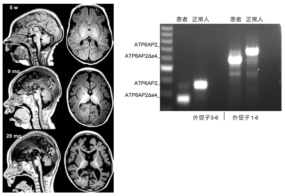 日法多国联合查明基因突变引发脑萎缩的部分发病机制
