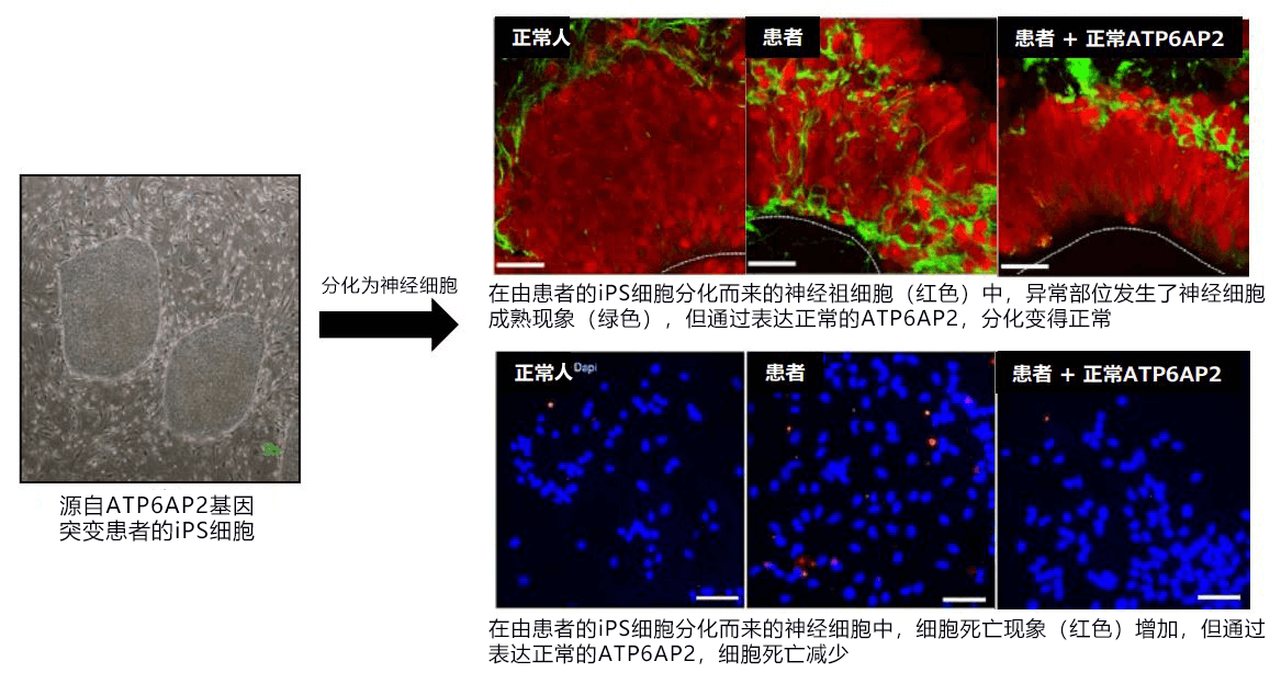 日法多国联合查明基因突变引发脑萎缩的部分发病机制