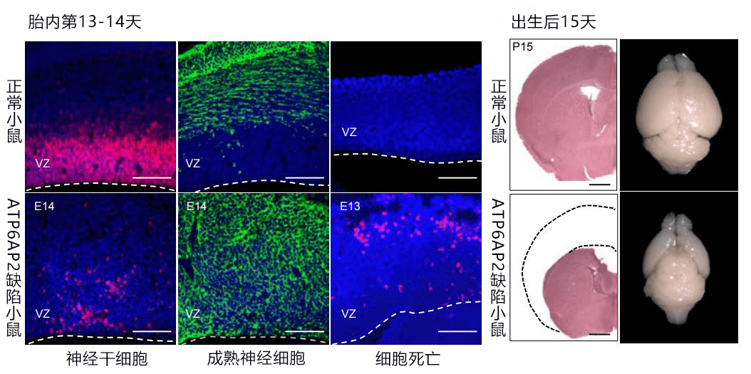 日法多国联合查明基因突变引发脑萎缩的部分发病机制