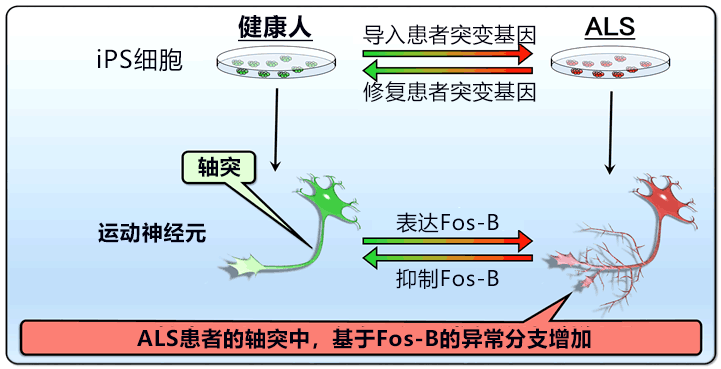 日本通过iPS细胞发现渐冻症新病理，有望用于早期靶向治疗