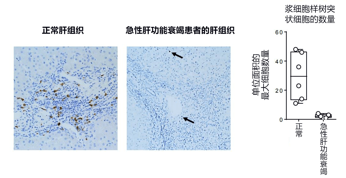 日本发现控制急性肝衰竭的新型免疫细胞，有望开发新治疗方法