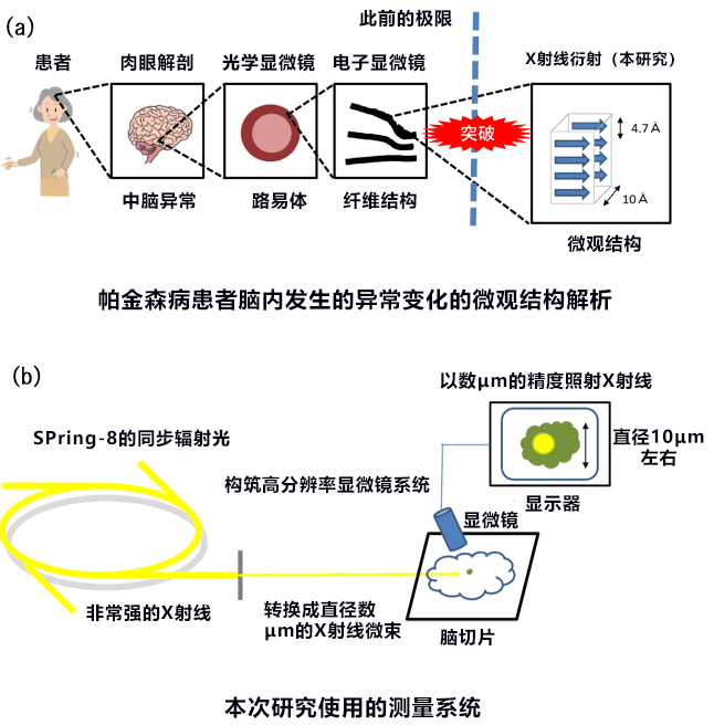 大阪大学等证实帕金森病是淀粉样变病的一种