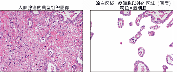 日本发现抑制胰腺癌恶化的新型细胞,有望开发改变癌细胞周围环境的新疗法