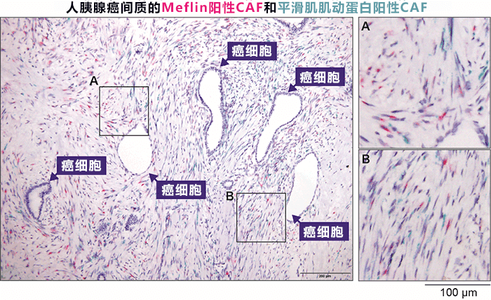 日本发现抑制胰腺癌恶化的新型细胞，有望开发改变癌细胞周围环境的新疗法