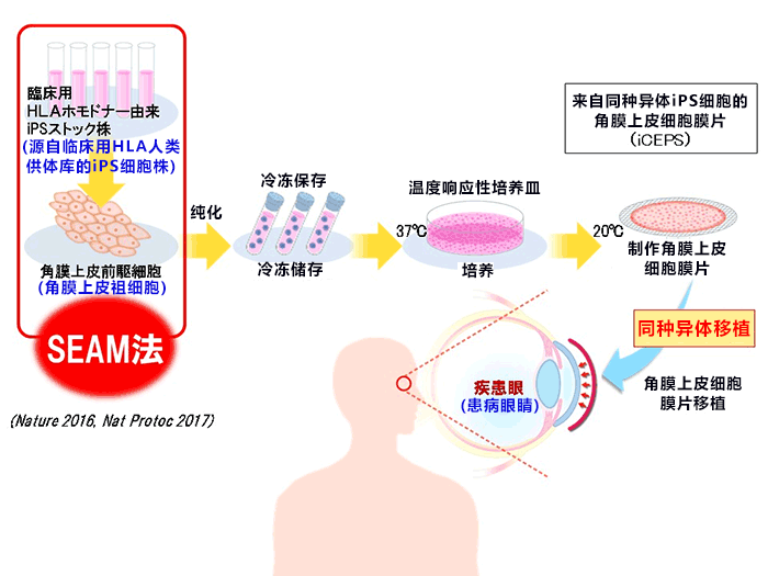 阪大实施全球首例iPS细胞角膜移植，患者出院年内实施第二例