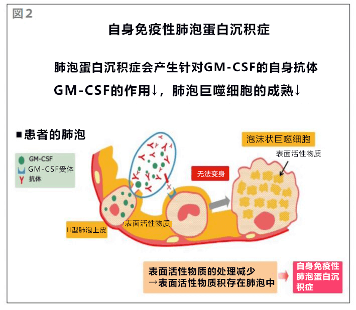 千叶大学等验证吸入疗法对难治性呼吸系统疾病的效果,可治疗自身免疫性肺泡蛋白沉积症