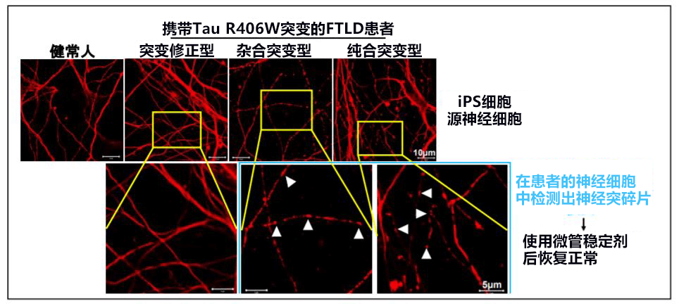 日本培养出家族性痴呆症iPS细胞，有望根据Tau蛋白异常开发治疗药物