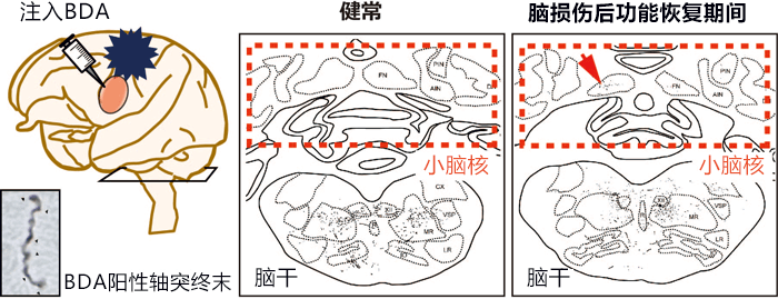 脑损伤后可形成新的神经束，适当促进大脑变化可恢复运动功能