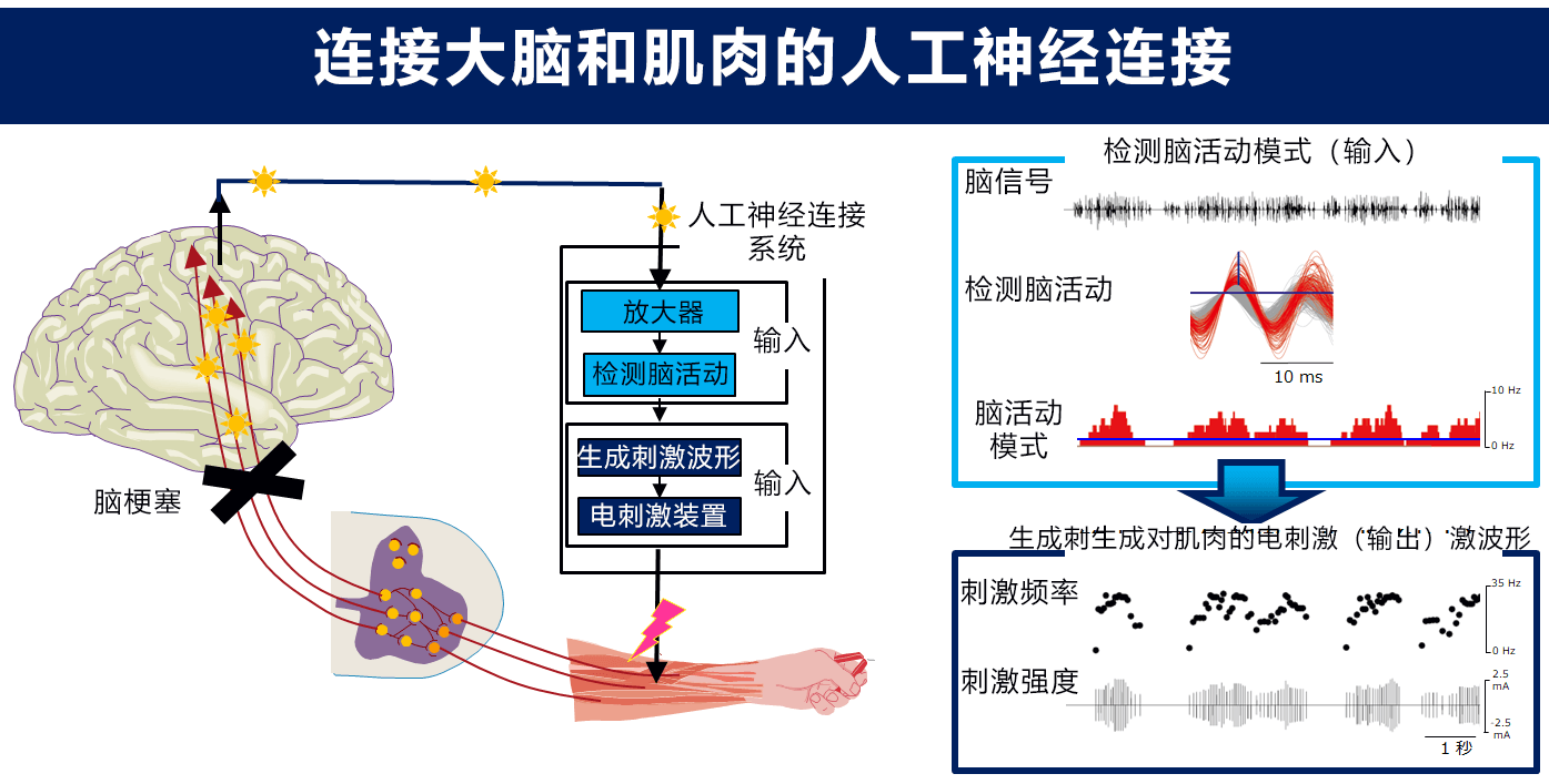 人工神经连接系统让脑梗塞患者重拾手部运动功能